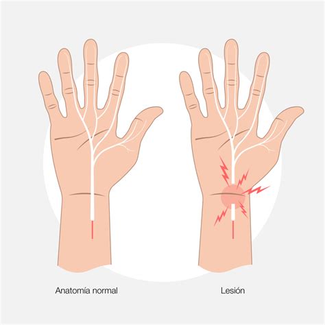 Tendinitis De Mu Eca Cl Nica Cemtro