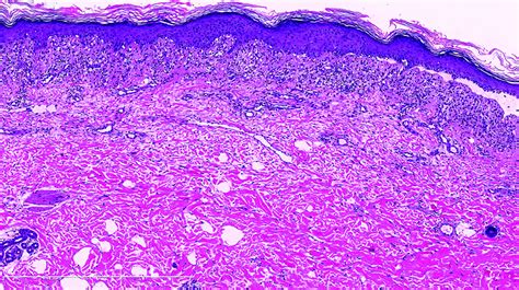 Mercury Induced Cutaneous Poisoning With Generalised Erythema And Pruritic Blister Indian