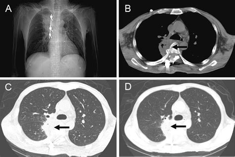 The Right Lung Abscess Still Existed But The Pneumonia Was Alleviated Download Scientific