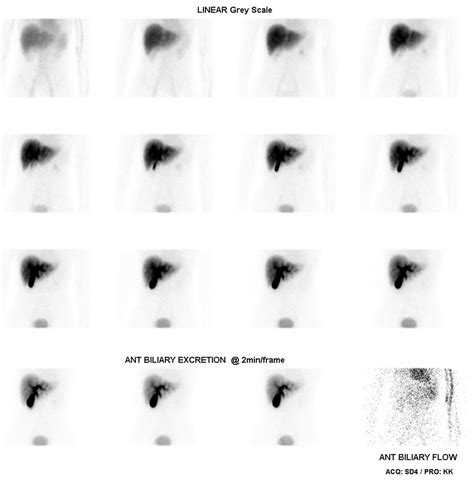 Hida Scan Procedure Scan Results Scan Side Effects