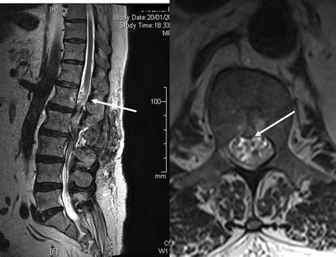 Late Diagnosis Of Spinal Dural Arteriovenous Fistulas Resulting In