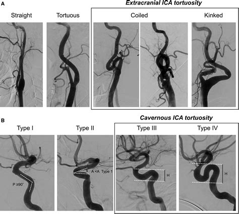 Internal Carotid Artery Tortuosity Impact On Mechanical Thrombectomy