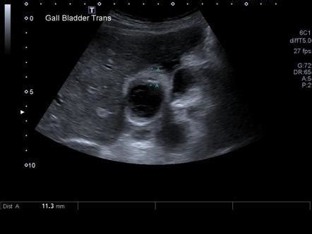 Emphysematous cholecystitis | Radiology Reference Article | Radiopaedia.org