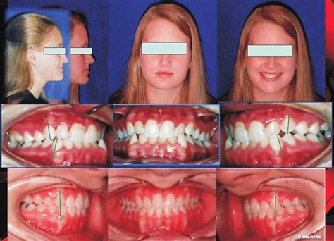 Mild Class Iii Protraction2 After 20 Months Of Direct Application Download Scientific