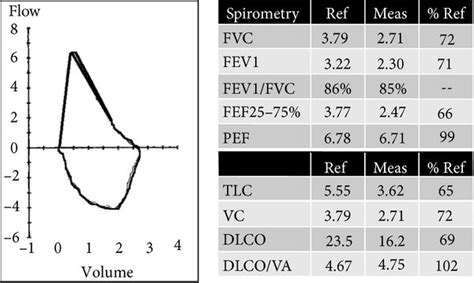 Left Spirometry Demonstrating A Flow Volume Loop With A Restrictive