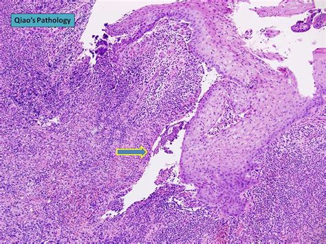 Qiao s Pathology Subareolar Breast Abscess 乔氏病理学乳晕下乳腺脓肿 Flickr