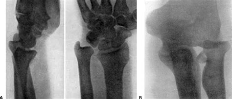 Figure 1 From A Historical Perspective On The Essex Lopresti Injury