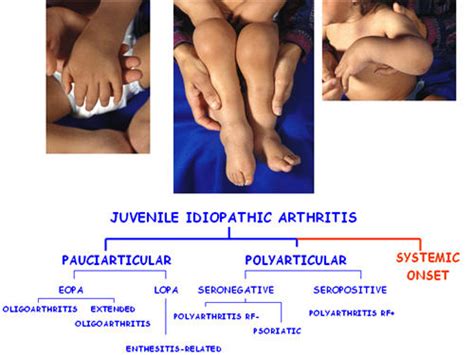 Diagnosis Juvenile Idiopathic Arthritis Diagnosis