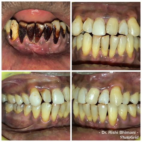 Tobacco Chewing And Smoking Affect The Teeth Gums