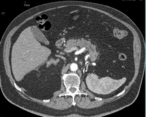 Recurrent Renal Cell Carcinoma With Enhancing Right Adrenal Metastases