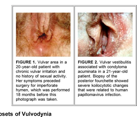 Figure 2 From Vulvodynia And Vulvar Vestibulitis Challenges In Diagnosis And Management