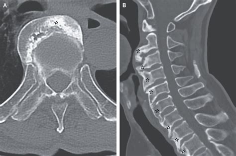 Diffuse Idiopathic Skeletal Hyperostosis