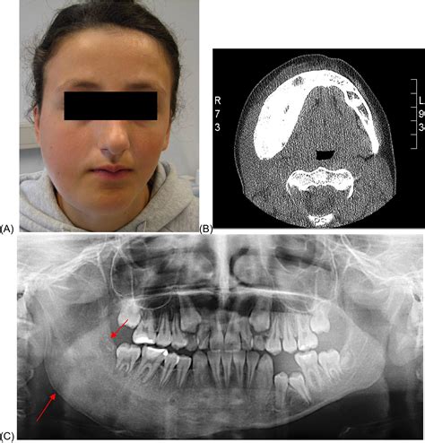 Primary Chronic Osteomyelitis Of The Jaw—a Microbial Investigation Using Cultivation And Dna