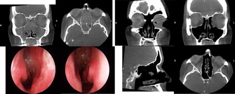 Sinus Surgery For Nasal Polyposis Prof Richard Harvey