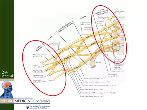 Radiculopathy Vs Peripheral Neuropathy Ppt