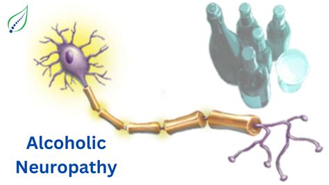 Alcoholic Neuropathy: Symptoms, Causes, & Treatment | Best Back Pain ...