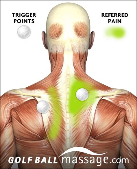 Trigger Points Trigger Point Massage Referred Pain Trigger Points Trigger Point Therapy