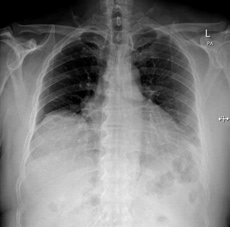 Postero Anterior A And Lateral View Chest X Ray Showing Homogenous