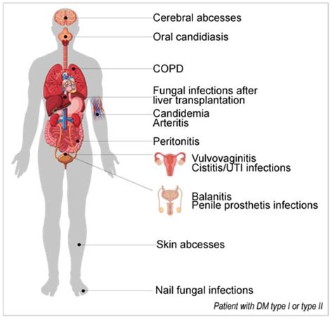 Jcm Free Full Text Candida Sp Infections In Patients With Diabetes