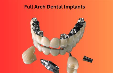 Full Arch Dental Implants - Everything You Need To Know - Oral Health Line