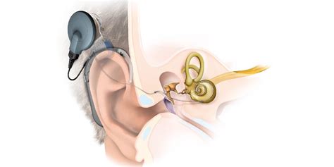 Implante Coclear Um Dispositivo Eletrônico Que Substitui O Ouvido