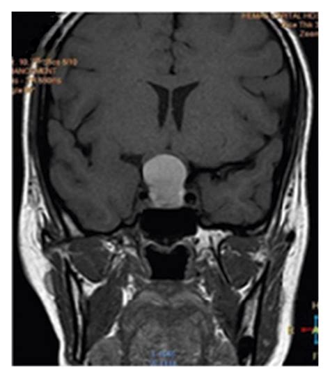 MRI Of This Patient Showing Lobular Tumor Occupying Sellar And