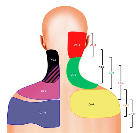 Evidence Based Pain Referral Patterns Download Scientific Diagram