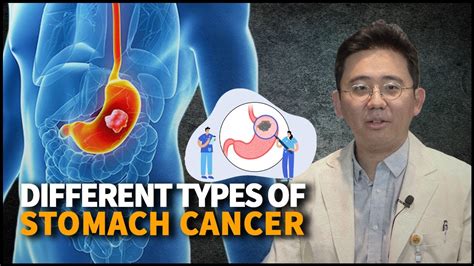 Different Types Of Stomach Cancer Causes Symptoms And Preventions