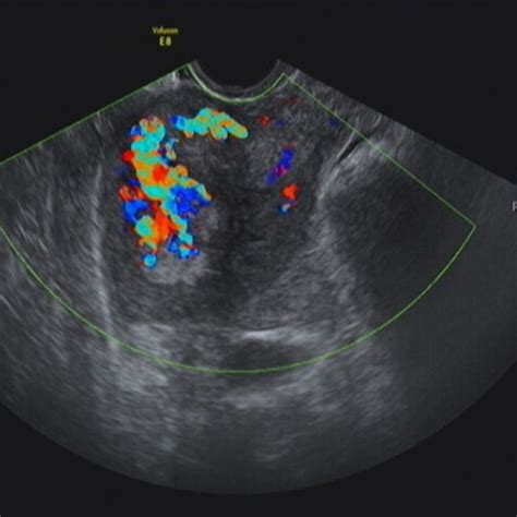 The Color Doppler Flow Ultrasound Image Of The Same Woman Download Scientific Diagram