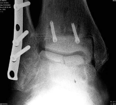 Figure From Fresh Osteochondral Total Ankle Allograft Transplantation