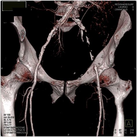 Common Iliac Artery Aneurysm