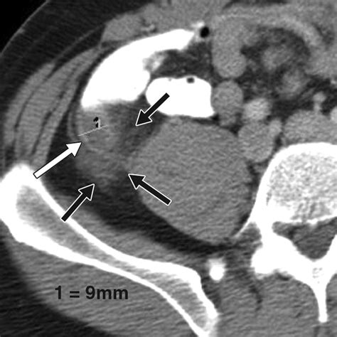 Patterns Of Fat Stranding Ajr