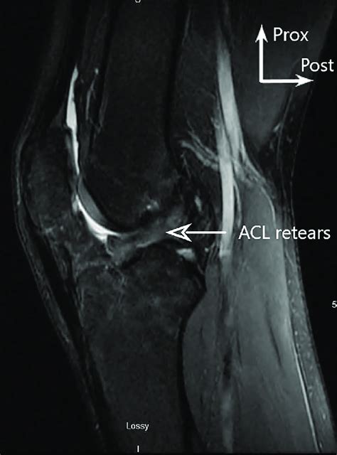 Acl Graft Retear Preoperative Magnetic Resonance Imaging With Sagittal