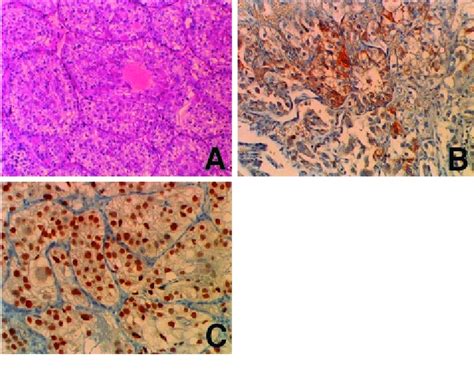 A Photomicrograph Of The Surgical Specimen Hematoxylin And Eosin