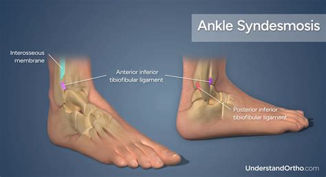 Ankle Sprain High Understandortho