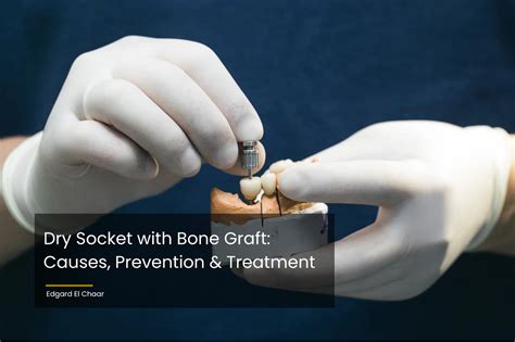 Dry Socket With Bone Graft Causes Prevention Treatment