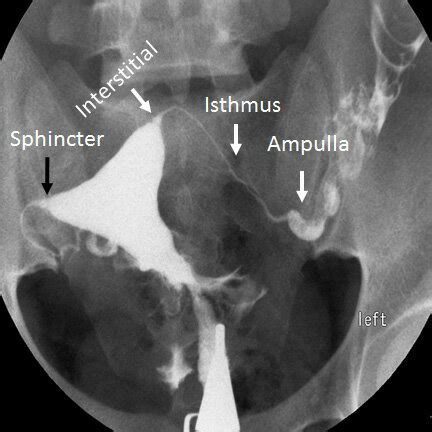 Different parts of normal fallopian tubes. 1. Intramural, 2. Isthmus,... | Download Scientific ...