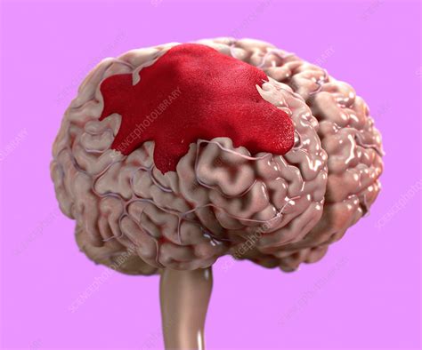 Brain Haemorrhage Illustration Stock Image F0202451 Science