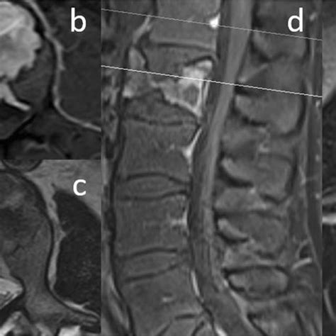 A B Preoperative Sagittal And Axial T Weighted And Contrast Enhanced