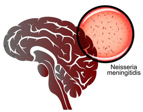 Meningite Sintomas Transmissão Tratamento Brasil Escola