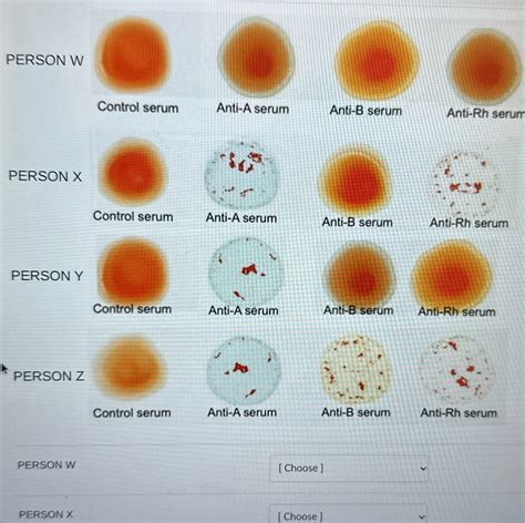 Solved Person W Control Serum Anti A Serum Anti B Serum Anti Rh Serum