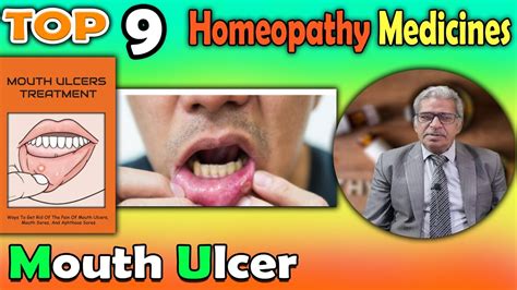 Mouth Ulcer Causes And Homeopathy Treatment Dr P S Tiwari Youtube