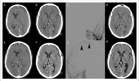 Figure 2 From Chronic Subdural Hematoma Recurrence Due To Contralateral