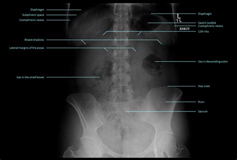 Labeled Abdominal X Ray