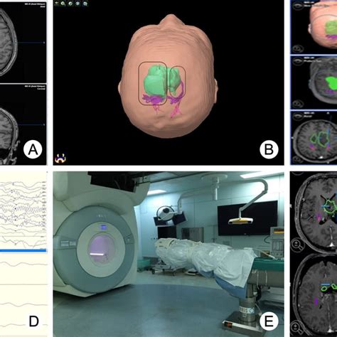 Resection Procedure Assisted By Multimodal Techniques A Preoperative Download Scientific