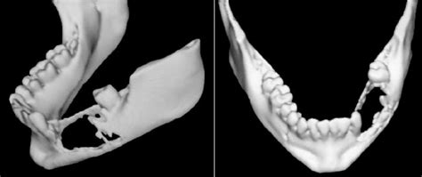 Three-dimensional reconstruction of the mandible illustrating the tumor ...