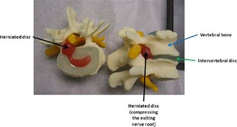 Disc Herniation Ashburn Va Spinal Stenosis Reston Va