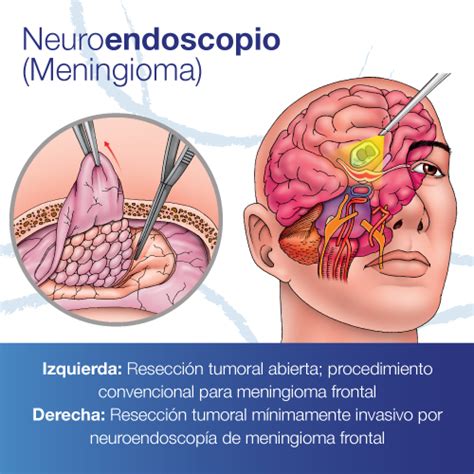 Cirugía de Meningiomas Dr Juan Francisco Lasso