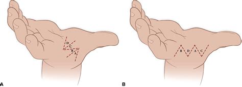 Reconstruction Of The Hypoplastic Thumb Journal Of Hand Surgery