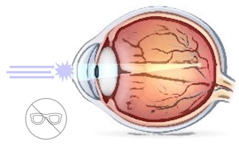 Opération de la myopie laser LASIK PKR RELEX SMILE